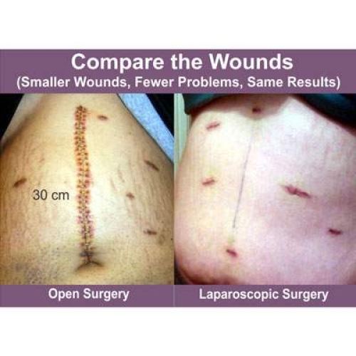 Stomach cancer