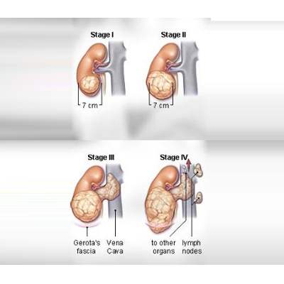 Kidney Cancer