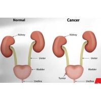 Prostate Cancer