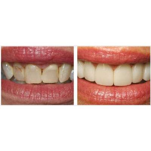 Ceramic Veneers