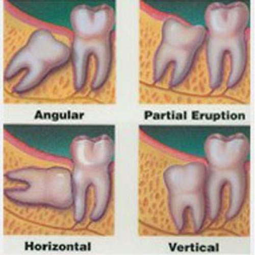 Oral Surgery and Tooth Removal