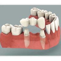 Tooth Supported Bridge