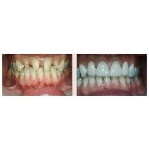 Metal Free Crowns