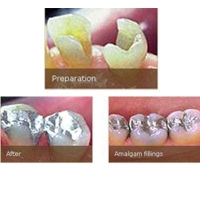 Dental Fillings