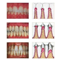 Gum Treatment