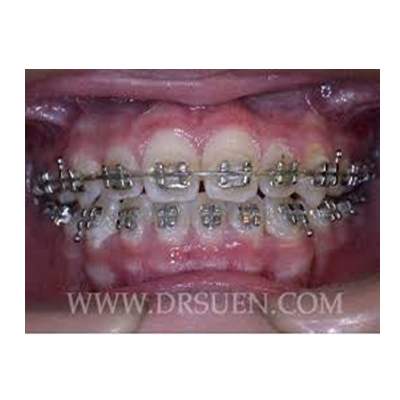 Orthodontics Treatment