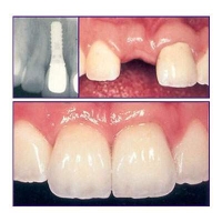 dental implant