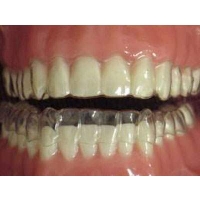 Invisalign braces