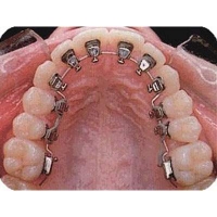 Lingual and invisible Braces