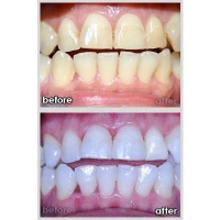 Whitening Bleaching
