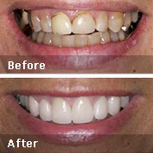 Ceramic Crowns
