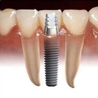 Dental Implants