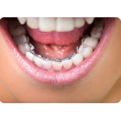 Invisible Braces