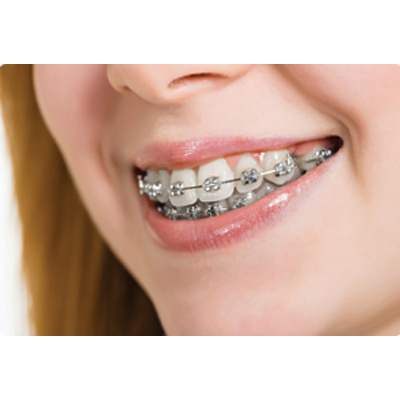 Metal Braces