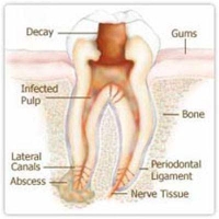 Root Canal Treatment