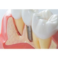 Dental Implants