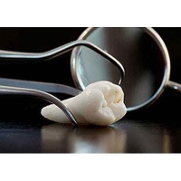 Extractions Wisdom Teeth Removal