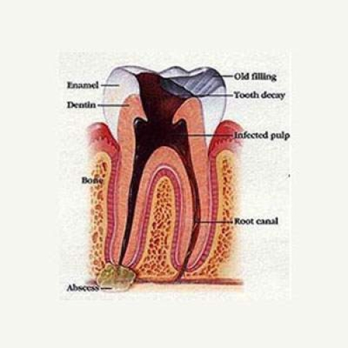 Root Canal Therapy