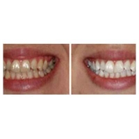 Tooth Whitening