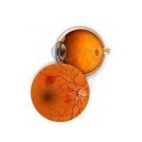 Diabetic Retinal