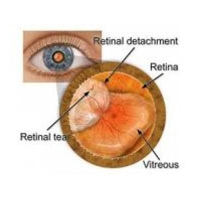 Retinal Reattachment
