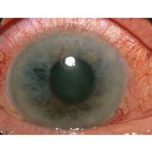 Glaucoma